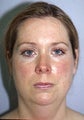 Before and After Chin Implant With Liposuction (Front View)