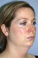 Before and After Chin Implant with Liposuction (Quarter View)