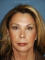 Chin augmentation with facial rejuvenation