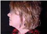 chin liposuction with platysmal plication (mini necklift)