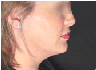 chin lipo with platysmal plication (mini necklift)