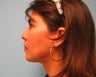 liposuction of chin