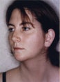 Neck Liposuction