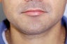 Neck Liposuction
