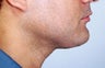 Neck liposuction
