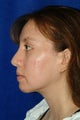 Rhinoplasty, chin implant, chin liposculpture, cheek fat pad removal