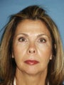 Chin augmentation with facial rejuvenation