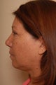 Liposuction of the Neck