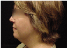 chin liposuction with platysmal plication (mini necklift)