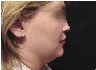 chin lipo with platysmal plication (mini necklift)