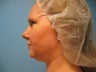 chin liposuction