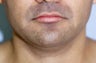 Neck Liposuction