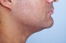 Neck liposuction
