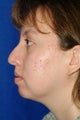 Rhinoplasty, chin implant, chin liposculpture, cheek fat pad removal
