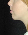 Chin Implant