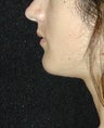 Chin Implant