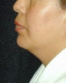 Chin Implant