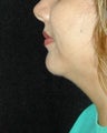 Chin Implant Surgery