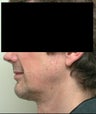Neck Lift and Chin Implant