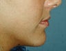 Chin Augmentation