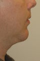 Chin augmentation, neck liposuction, and neck muscle tightening