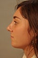 Chin surgery in the young