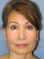 Chin Augmentation