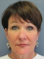 Chin Augmentation