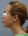 Chin Augmentation