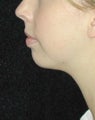 Chin Implant