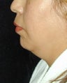 Chin Implant