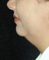 Chin Implant Surgery