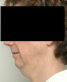 Neck Lift and Chin Implant