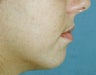 Chin Augmentation