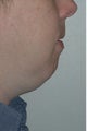 Chin augmentation, neck liposuction, and neck muscle tightening