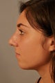 Chin surgery in the young