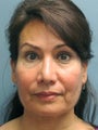 Chin Augmentation