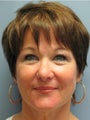 Chin Augmentation