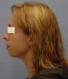 Chin Augmentation