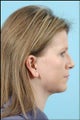 Chin Implant