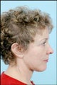 Chin Implant