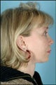 Chin Implant