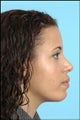 Rhinoplasty / Chin Implant
