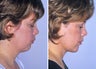 Liposuction of neck and chin augmentation