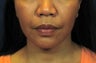 Chin Implant with Laser Facelift