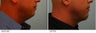 Chin Implant and Neck Liposuction