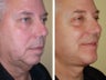 Chin Augmentation