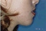 Chin Implants