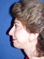Chin Implants