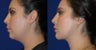 Liposuction of neck with chin implant